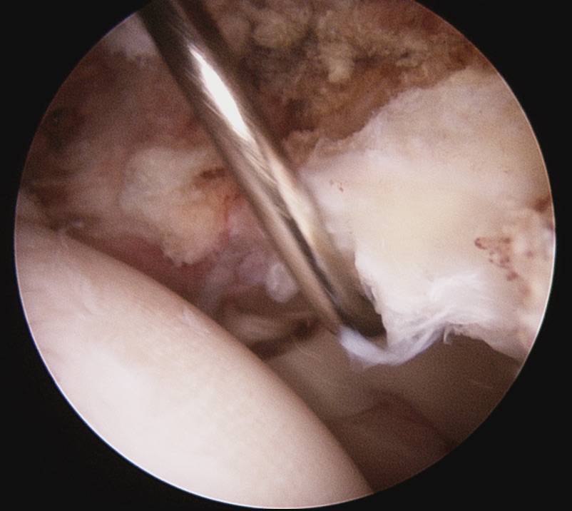 Femoroacetabular Impingement