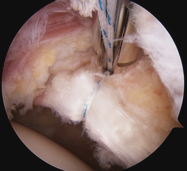 Femoroacetabular Impingement