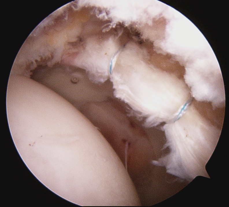 Femoroacetabular Impingement