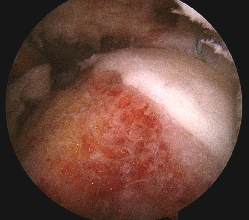 Femoroacetabular Impingement