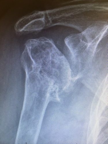 Shoulder Arthritis