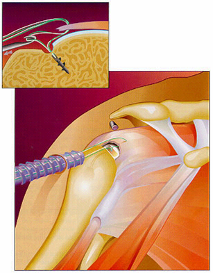 Rotator Cuff Repair