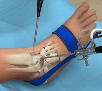 Ankle Arthroscopy