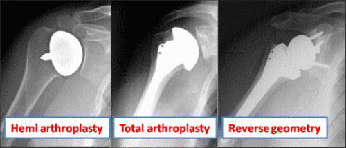 Shoulder Replacement