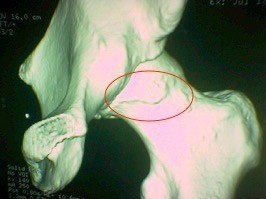 Femoroacetabular Impingement