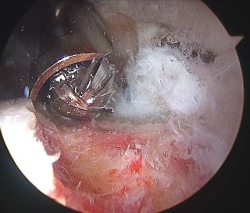 Labral Tear