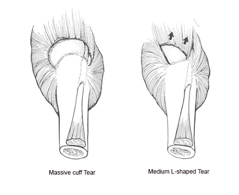 Rotator Cuff Repair