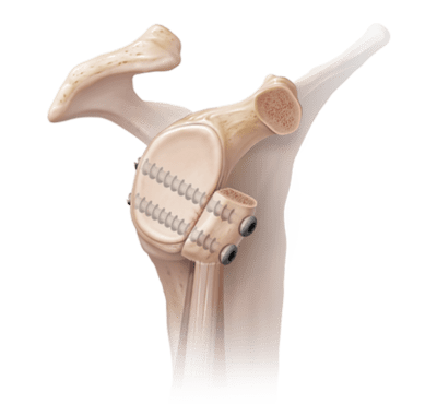 Shoulder Instability – Bankart tear