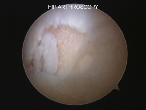 Femoroacetabular Impingement