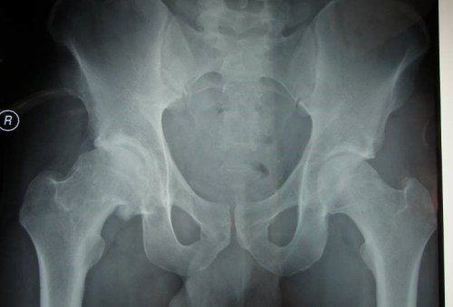 Femoroacetabular Impingement