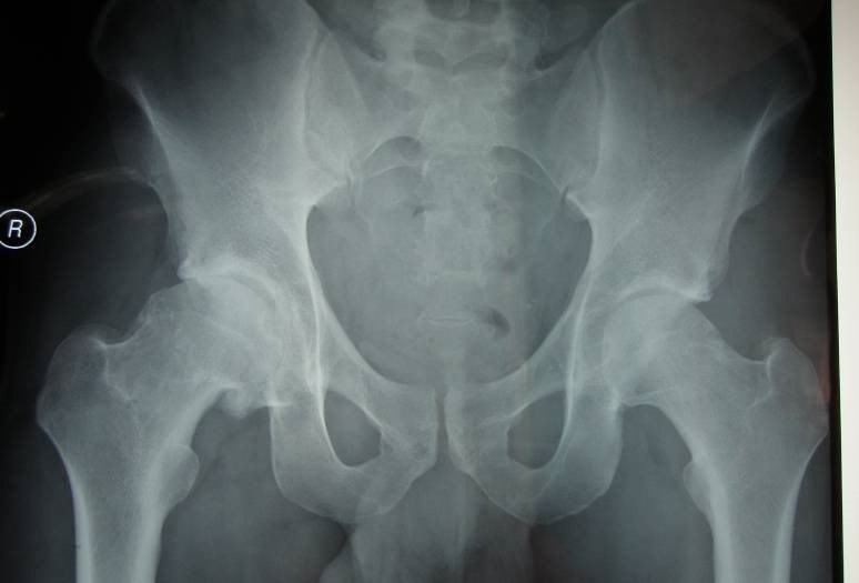 Hip Arthritis