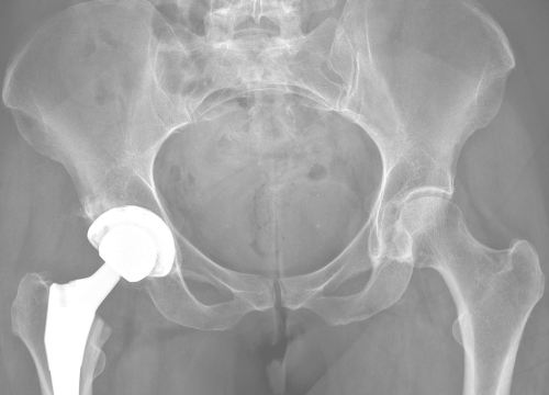 Hip Replacement