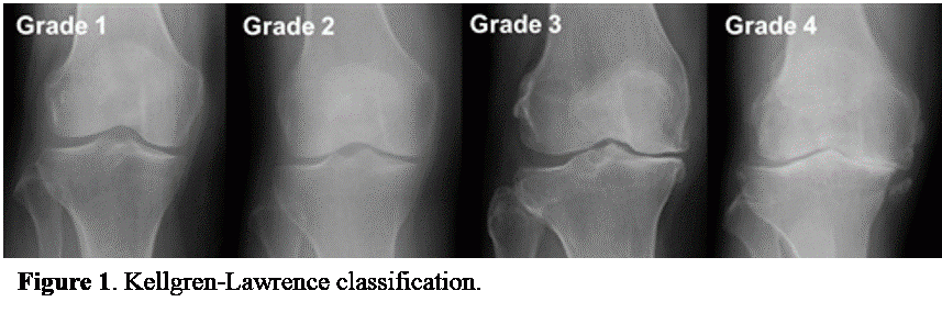 Knee Arthritis