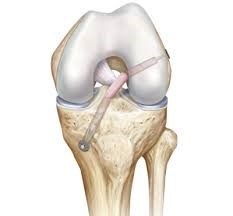 ACL Reconstruction