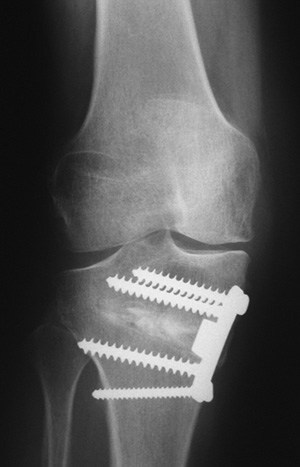 Knee Osteotomy