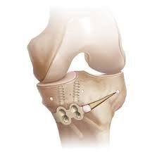 Knee Osteotomy