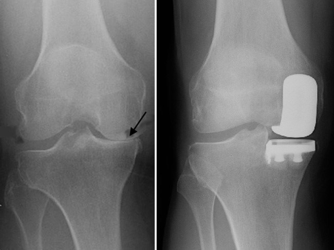 Partial Knee Replacement