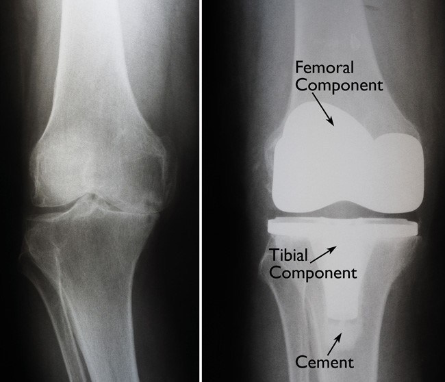 Total Knee Replacement