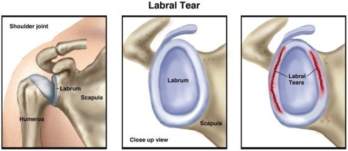 Shoulder Instability – Bankart tear