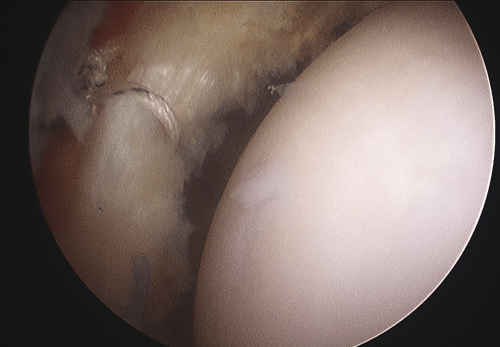 Labral Tear