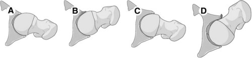 Femoroacetabular Impingement