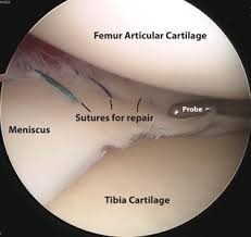 Meniscus Tear