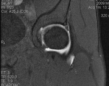 Labral Tear