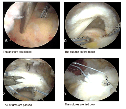 Rotator Cuff Repair