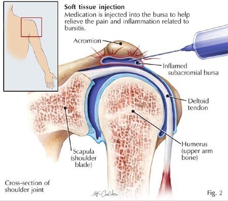 Impingement Syndrome & Rotator Cuff Tears