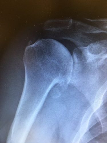 Shoulder Arthritis