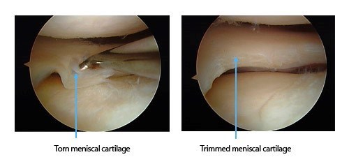 Meniscus Tear