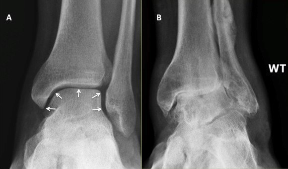 Ankle Arthritis